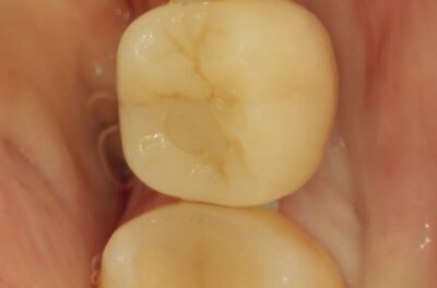 Изображение - Протезирование коронками из диоксида циркония