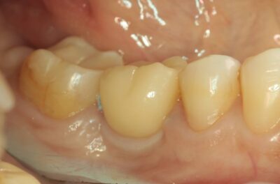 Изображение - Протезирование коронками из диоксида циркония