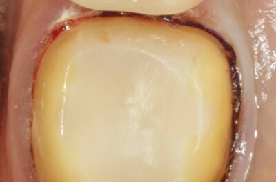 Изображение - Протезирование коронками из диоксида циркония