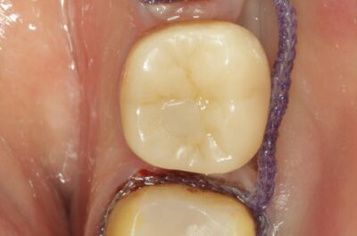 Изображение - Протезирование коронками из диоксида циркония