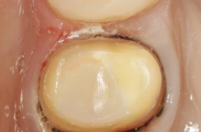 Изображение - Протезирование коронками из диоксида циркония