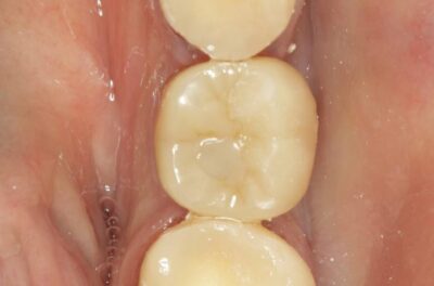 Изображение - Протезирование коронками из диоксида циркония