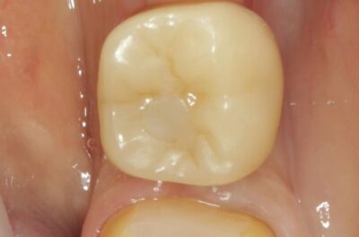 Изображение - Протезирование коронками из диоксида циркония