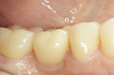 Изображение - Протезирование коронками из диоксида циркония