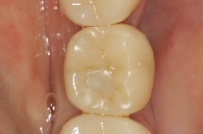 Изображение - Протезирование коронками из диоксида циркония