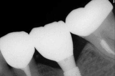Изображение - Протезирование коронками из диоксида циркония